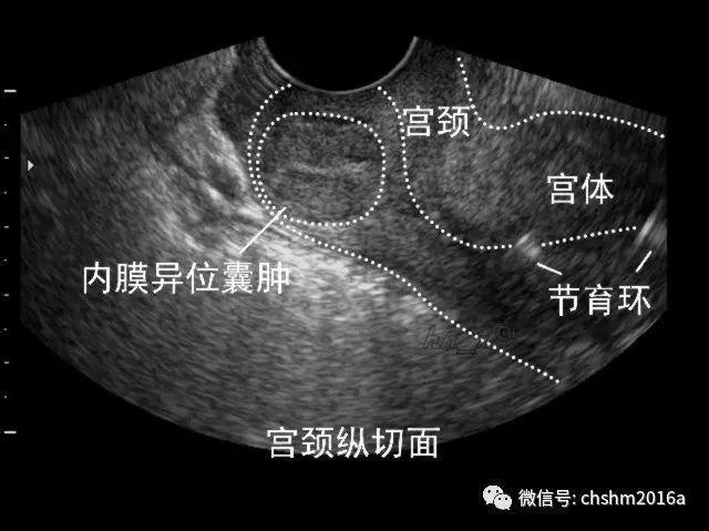供卵试管婴儿移植后1-10天的感觉
