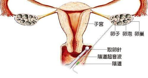 做试管多久可以上班