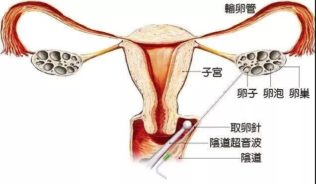 2023试管婴儿多少钱